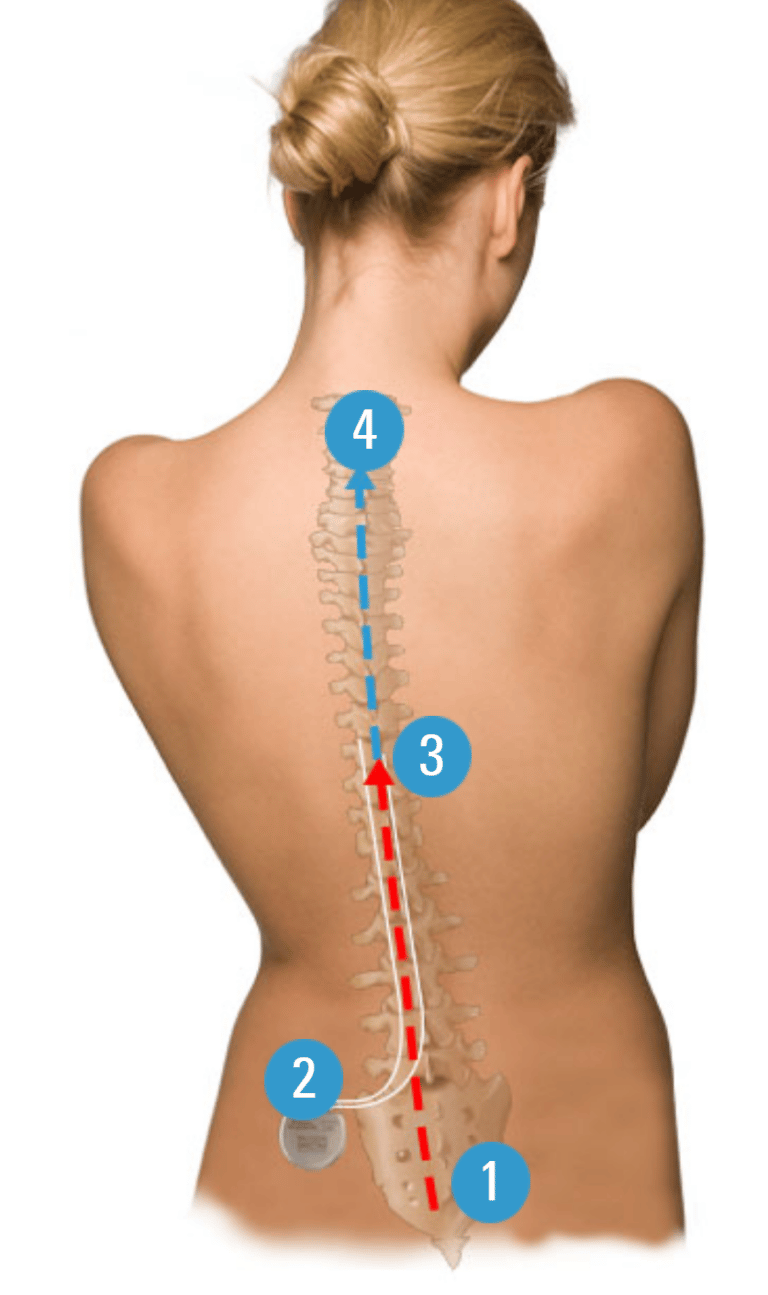 living with a spinal cord stimulator