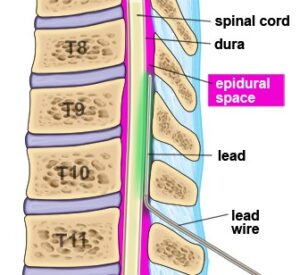 Implanted Devices Scs 