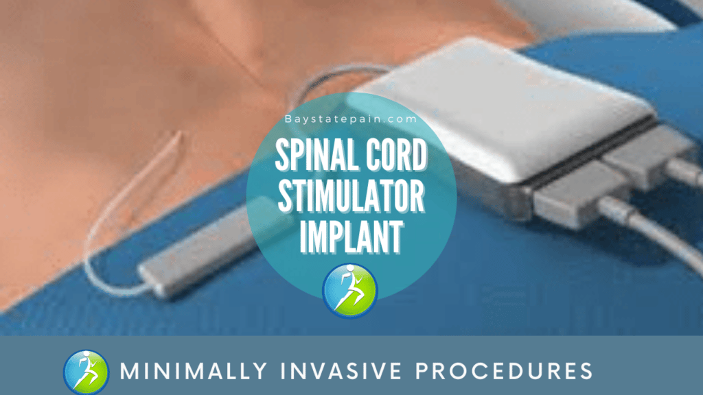 Spinal Cord Stimulator: FAQ: Bellevue Pain and Wellness PLLC: Pain  Management Physicians